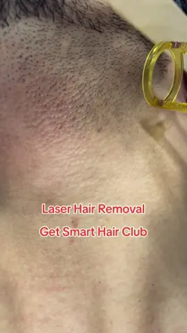 Laser Hair Removal #getsmarthairclub_ #peshawar #laser #hair #removal #LaysCricketFan #fypシ #2023 #follow #foryourpage #LaysEverywhere #DilKiBaat 