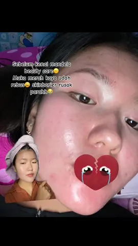 Sebelum kenal mandela beauty care muka merah , skinbarier rusak 😭😭  Setelah kenal mandela, nggak ketemu lagi sama muka merah 😂 yang ada muka glowing sehat tiap hari😍😍 #skincaremurahcheck #mandelabeuatycare #dnasalmon #glowing7hari #fyppppppppppppppppppppppp #promombc #flekmenahun #menghilangkanbopeng #diskonmbcskincare #memutihkan6xlipat #skincareroutine 