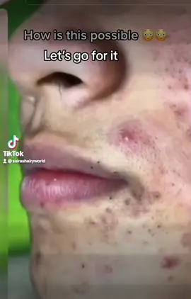 #whiteheads #extractions #moutharea #skincare #usa #romania #somalitiktok #viralvideo #fyp 