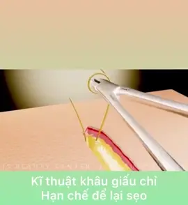 Kỹ thuật khâu giấu chỉ Thẩm Mỹ không sẹo  #khâugiấuchỉ #khâuthẩmmỹ #phẫuthuậtthẩmmỹ 