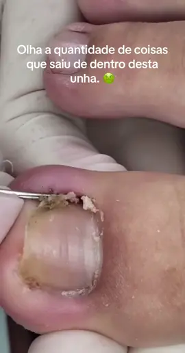 Tirando unha encravada, vídeo satisfatório. #asmrvideo #asmr #asmrvideosontiktok #asmrtiktoks #satisfyingvideo #satisfying #asmrunhaencravada #unhaencravada #videosatisfatorio #unhainflamada 