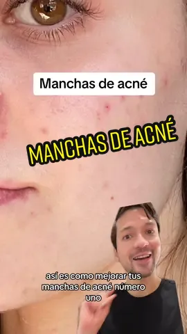 Tips para eliminar las manchas de acné #skincare #skincaretips #acne #acnetips #manchasdeacne #niacinamida #azelaico #tranexamico #retinal #retinol #barreracutanea #manchasenlapiel #greenscreen 