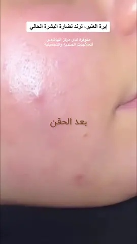 ابرة العنبر 💉✨ الترند الحالي لنضارة البشرة 🤎✨ ##ابرة_العنبر_لنضارة_الوجه #ابرة_العنبر #عناية_بالبشرة #مركز_الهاشمي_للعلاجات_الجلدية_والتجميلية #اهتمام_وعنايه #ليبيا🇱🇾 #ليبيا #طرابلس #جنزور #جنزور_السياحية_السراج #نضارة_البشرة 