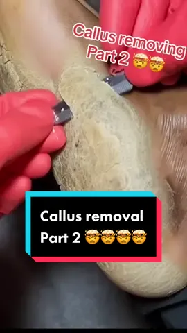 #callusremoval #calluses #callusedfeet #feetcare #removal #plantarcallus #satisfying #oddlysatifying 