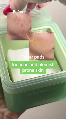 Toner pads for acne and blemish prone skin✅ @Mediheal Us  #mediheal #medihealtonerpad #tonerpad #teatree #acneproneskin #blemishproneskin #troubleskinsolution 
