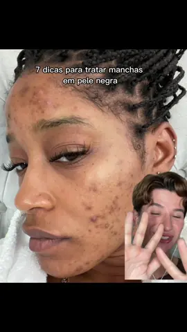 7 dicas para tratar hiperpigmentação (manchas) na pele negra.  #manchasnapele #manchasnorosto #hiperpigmentacao #pelenegra #pelesaudavel #peleperfeita #skincareminimalista #dicasdebeleza #cuidadocomapele #acidosnapele 