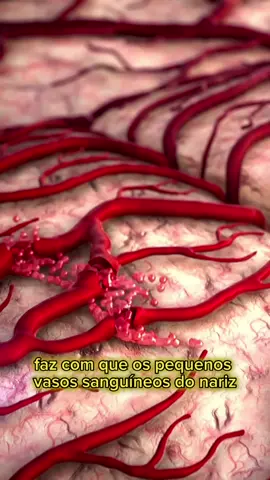 🩸EPISTAXIS = SANGRAR PELO NARIZ 👃  😵‍💫QUANTAS CRIANÇAS TÊM ISTO? Estima-se que 30% das crianças dos 0-5 anos, e 50% das crianças > 5 anos, possam ter episódios de epistaxis. 🤧CAUSAS As causas + frequentes são aquelas que provocam algum tipo de inflamação, irritação ou lesão da mucosa nasal: - Ar quente e seco - Alergias - Meter os dedos no nariz - Trauma nasal (queda ou colocar coisas no nariz) - Constipações Existem outras causas muito raras que devem ser excluídas em caso de crianças com epistáxis de forma muito repetida. ⚠️O QUE FAZER? 1 – Tranquilize o seu filho, sente-o e incline a cabeça ligeiramente para a frente. 2 – Aperte a parte mole do nariz, logo abaixo do osso 3 – Peça ao seu filho para respirar pela boca. 4 – Se tiver uma compressa fria pode pinçar com a compressa. 5 – Manter os pontos anteriores durante 10 minutos. 6 – Após os 10 minutos, retire a pressão e verifique o nariz.  7 – Se voltar a sangrar, faça mais 10 minutos de pinça. 8 – Se ao fim deste tempo ainda sangrar, dirija-se ao hospital. ⛔️O QUE NÃO FAZER? - Não incline para trás (risco de engolir sangue e engasgar-se). - Não colocar a cabeça muito para a frente, deitada entre os joelhos. - Não carregue no osso do nariz entre olhos (não funciona). - Não coloque nada dentro do nariz. - Não largue o nariz antes de passarem 10 minutos ✅COMO PREVENIR? - Humidificador – pode usar em casa se a casa for muito seca - Hidratação nasal regular com água do mar - Não meter o dedo no nariz ❌O QUE NÃO FAZER APÓS EPISTAXIS? - Não levantar coisas pesadas - Não inclinar para a frente - Não assoar o nariz com força #opediatra #opediatrapt #pediatra #pediatria #epistaxis #nariz #bebes #crianças #adolescentes #saude #medicina 