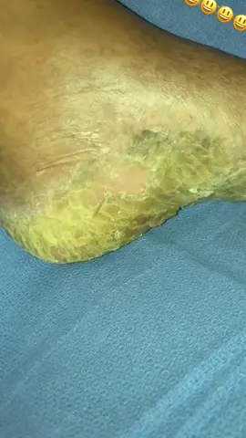 Provolone flavored cheese feet 👣 #footpain #fyp #viralvideo #satisfying #callusremoval #painful #podiatry #satisfyingvideo #myfootarekillingme #callus #trendingvideo #calluses #healthyfeetpodiatry #pedicure #crackedfeet @FootWorks Relaxing 