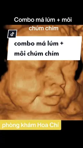 View triệu đô cho các ba mẹ. Nhả vía combo má lúm và môi chúm chím baby #babycute #sieuam5d #sieuamthai #sieuamthai5d #conyeu #bameyeucon #view #xuhuong #ticktock #viral #fybシ #trending #embedangyeu #malumababy #embedethuong #sanphukhoa 