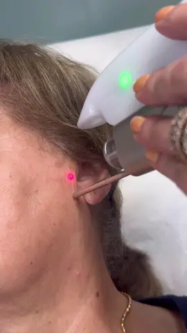 Have a problem with ringing in your ears or tinnitus? 👂 We’ve got a solution for you! Using Fotona’s Laser machine to treat tinnitus 😍 💥Laser treatment in tinnitus involves the stimulation of cellular activity, increased blood flow, and the reduction of inflammation or oxidative stress in the auditory system  👩🏻‍⚕️Our Nurse Practitioner, Lousine, can generate a treatment plan specifically for you!  📲 DM us or call (818)578-4455 for all appointments/questions!  #losangeles #glendale #botox #neurotoxin #medspa #nurse #aestheticnurse #fillers #beauty #SelfCare #wrinkles #wrinklefree #antiaging  #ConfidenceBoost #BeautyEnhancement #aesthetics  #medspa #transformation #MedSpaMagic #EnhanceYourBeauty #fotona #fotonalaser #tinnitus #ringingears #earringing #fyp 