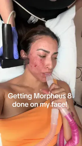 Getting morpheus 8 session 3 done today! Have you ever had this done? Its so good for anti aging and acne scarring  #morpheus8 #morpheus8treatment  #antiaging 