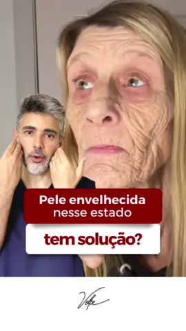 Muitas pessoas não sabem, que em até casos como esse existem soluções. Por diversos fatores algumas mulheres não conseguem fazer um tratamento preventivo e chega em um momento da sua vida e se perguntam:  “Mas será que ainda consigo reverter essa situação?’’. No vídeo trago uma opção de tratamento que atua nesses casos mais avançados, tratando com eficácia e naturalidade. #pele #envelhecimento #estimulodecolageno #colageno #rugas #rejuvenescimento #croton