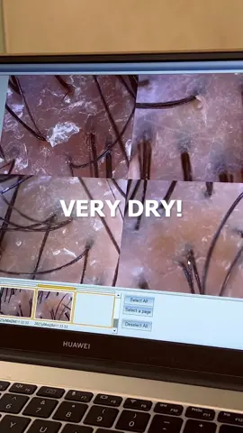 ASMR: Scalp Massage Treatment for Hair Growth and Sensitive Skin! #asmr #asmrmassage #scalpmassage #hairgrowth #scalptreatment