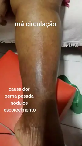 massagem melhora circulação  #macirculacao  #pernainchada  #angiologista  #massoterapeuta 