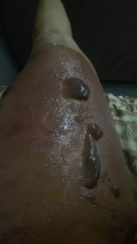 O dia q queimei minha coxa com água quente #queimadura #foryou #foryoupage 