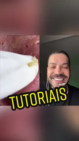Gente é um nariz com muito cravo! Tranquilamente essa pessoa emagreceu depois dessa extração. #cleaning #cravos #ameinota2 