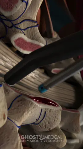Ghost Medical provided Medtronic with an animation of its Aquamantys electrosurgical device in 2012. Aquamantys is a RF bipolar sealer that is used for hemostatic sealing and coagulation of soft tissue. The sealer provides significantly less blood loss, better visualization of surgical site, and less operating room time for certain procedures. In this animation, the device is used during a Posterior Lumbar Interbody Fusion (PLIF) operation. #medicaltiktok #processvideo #awareness #surgery #medtronic 