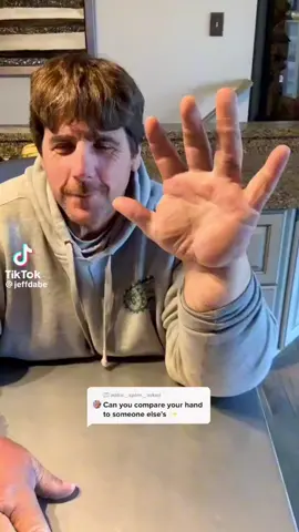 ‘Acromegaly’ is a rare condition where the body produces too much growth hormone causing body tissues and bones to grow more quickly. Over time this leads to abnormally large hands and feet and a wide range of other symptoms. #fypシ #ForYouPage #hand #Acromegaly 