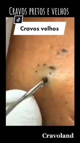 #limpezadecravos #remoçãodecravos #cravos #tirandocravo #videossatisfatorios #limpezadepele 