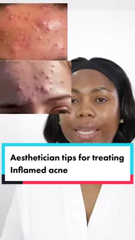 Treating acne can be very frustrating and stressful. As an Aesthetician i see people trying to dry it out or employ the most aggressive treatment option. In most cases this only worsens the matter.  Reducing inflammation and maintaining skin barrier should be your sole aim. Acne treatment | Acne breakout | inflamed acne| papules| skin disease | oilyskin|  #blackskincare #skincareroutine #acneskincareroutine #acneproneskincare 