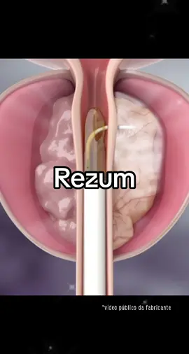 Rezum, a tecnologia que vai mudar paradigmas no tratamento da HPB #hiperplasiaprostatica #urologista #prostata #rezum 
