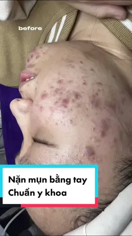 Khắc phục mụn sau 2 buổi điều trị tại Dr.skin Hải Phòng #mụn #bacsidalieuhaiphong #skincare #xh 