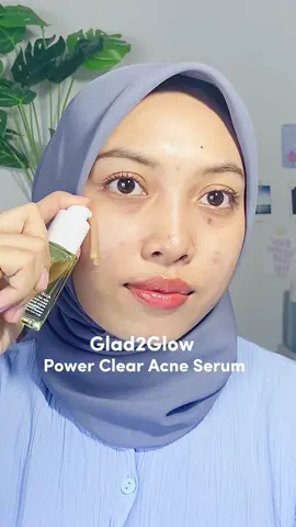 acne serumnya bisa dipakai mulai dari umur 13 tahun, gentle di kulit gaada rasa cekat cekit waktu dipakai 🥰 #acneserum #acneproneskincare #skincareaffordable 