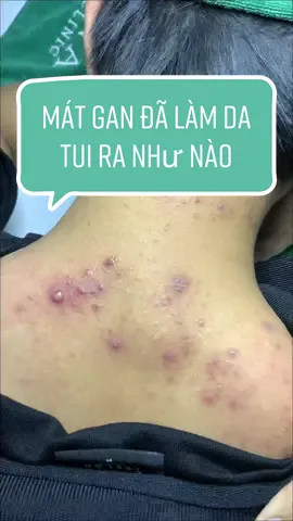 Mát quá trời mát nên mụn nó trồi lên hóng gió nè, mụn kiểu anh hối hận chưa #spa #trimun #hanaspagovap #hanagovap #trimungovap #spagovap #LearnOnTikTok 