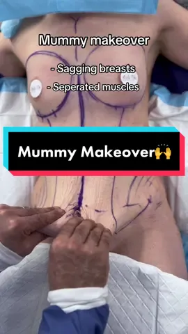 All the areas Mummy Makeover surgery treats 🙌  #mummymakeoversurgery #mummymakeover #bellavou #plasticsurgeryuk #tummytucksurgery #tummytuckjourney #mummymakeoverresults 