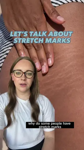 Friendly reminder this summer (and always!) that stretch marks are totally normal - and may even be influenced by your genetics.