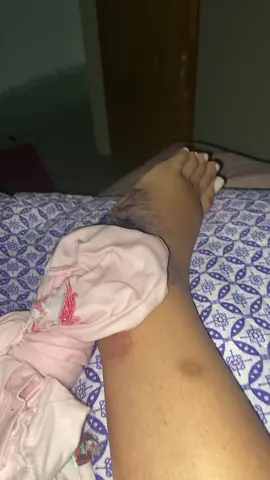Como se tivesse quebrado uma veia 😫 #tornozelotorcido #tornozelo #tornozeloquebrado😢🙄 #tornozelo #tornozelofraturado #tornozeloneymar #tornozeloquebrado #pe #tik_tok #fyp 