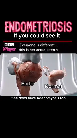Endometriosis affecta more than just reproduxtive organs . Thisnisnan example of uterus , tubes and ovaroes affected #endometriosis #endobattle #endo #endoawareness #endowarrior #endosisters #endowarriorstrong💛 #endobuddy #pain #chronicillness #chronicpain #🎗️ 