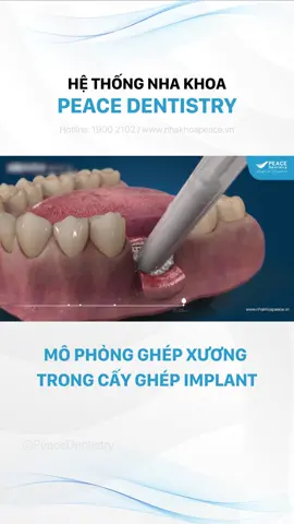 Ghép xương trong cấy ghép Implant là điều trị bổ sung cần thiết cho một số trường hợp phục hình răng hoặc cấy ghép Implant. Phương pháp ghép xương phổ biến nhất khi cấy ghép Implant đó là ghép xương nhân tạo, bao gồm: ghép xương nhân tạo dạng hạt với màng Collagen hoặc ghép xương nhân tạo dạng khối. Trong đó ghép xương nhân tạo dạng hạt thường được chỉ định hơn tại Peace Dentistry. #implant #cayghepimplant #trongrangimplant #LearnOnTikTok #nhakhoapeacedentistry #dentistryworld #nhakhoatphcm 