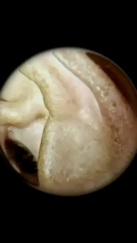 Guess how long he hasn’t cleaned his ears#earwax #earwaxremoval #satisfying #foryou #fyp#earcleaning #earcleaningtool #earwaxremoval #earcamera 