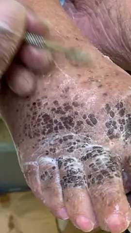 This is not dirt it’s skin scales #skin #debris #scales #podiatry #dermotology #cleanfeet #feet #dcfootdoctor #plaque #youtube https://youtu.be/au7kHYWFslY #bathe #cleanskin #elderly #eldercare #seniorcare #dirtyfeet 