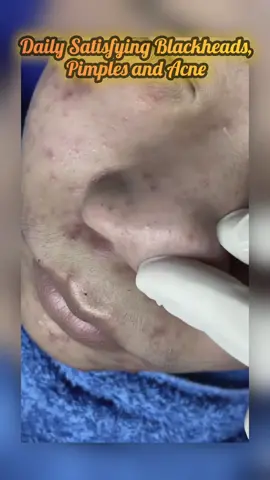Nose whiteheads #pimplepoppersatisfying #pimple #blackhead 