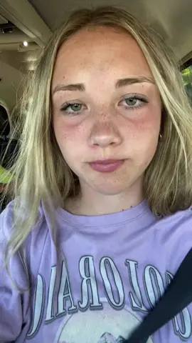 when even the eyes turn red😫 #fyp #foryoupage #relatable #Summer 