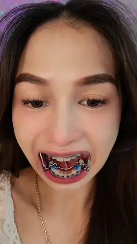 Replying to @niccolo.casciani Here you go 🤎 #fyp #foryou #foryoupage #foryoupageofficiall #foryoupage❤️❤️ #california #cali #bayarea #sanjose #gilroy #xycbafypシ #ortho #orthodontics #brace #tads #herbst #herbstappliance 