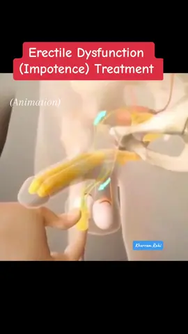 Erectile Dysfunction (Impotence) Treatment ✨ Most men suffering from impotence are well helped by conservative methods of treatment - psychotherapy, physiotherapy, various pharmacological preparations. If this is not enough, surgery comes to the rescue. Doctors, together with engineers, have developed a radical way to get rid of impotence - prosthesis of the penis. The operation is as follows: a small incision is made at the root of the penis. A silicone cylinder is implanted into the cavernous bodies. A pump is installed in the scrotum, and a balloon with liquid is placed under the bladder. 