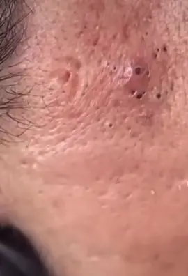 #removal #satisfying #blackheads #extractions 