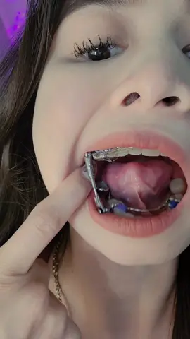 Replying to @yawazaki3 Suspension ! #fyp #fypシ #fypシ゚viral #tiktok #foryoupage #foryoupage #temporaryanchoragedevice #tads #herbst #herbstappliance #ortho #orthodontics #ohlins #ohlinssuspension #philippines #philippines #pinay #usa #usa_tiktok #california #gilroycalifornia #sanjose #bayarea 