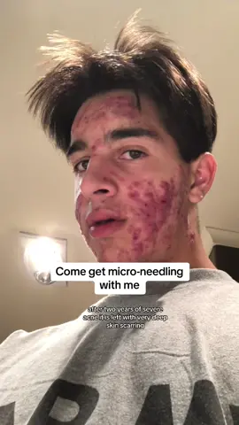 Come start a 12-week micro-needing treatment @Clear Skincare Clinics with me to treat my acne scarring.  #fyp #fypシ #gifted #viral #acne #accutane #transformation #skin #skincare #microneedling #microdermabrasion #treatment #scarring #acnefighter #motivation 