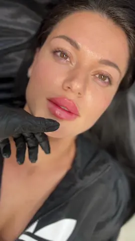 𝗧𝗲𝗰𝗵𝗻𝗶𝗾𝘂𝗲𝘀 𝗳𝗼𝗿 𝗖𝘂𝗽𝗶𝗱'𝘀 𝗕𝗼𝘄 𝗘𝗻𝗵𝗮𝗻𝗰𝗲𝗺𝗲𝗻𝘁💋 𝘚𝘺𝘮𝘮𝘦𝘵𝘳𝘺 𝘢𝘯𝘥 𝘉𝘢𝘭𝘢𝘯𝘤𝘦 The first step in injecting dermal fillers into the Cupid's bow is to ensure symmetry. Natalie will carefully measure and assesses the height, width, and shape of the Cupid's bow on both sides to identify any discrepancies.  The filler is then injected precisely to correct any imbalances and create symmetry. #lips #lipfiller #lip #russianlips #lipfillermasterclass #lipfillertraining #3dlips #russianlips #3dultrafinelips #russianlipstechnique #lipfillersouthampton #lipfillerlondon #fyp #fypage #foryou #trendingsound #trendingsong #russianlipstechnique 