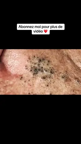 #blackhead #pimple366 #satisfying #pimplestreatment #pimple 