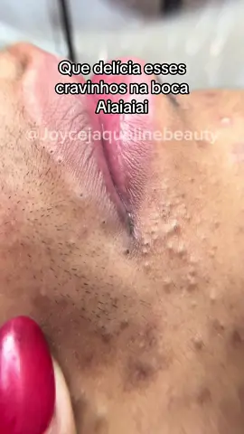 Meu Deus eu amooo 😮‍💨 #satisfatóriosvideos #tirandocravo #cravolovers #fy #lentemacro #cravoseespinhas #poppingpimples #satisfying #satisfyingvideo #limpezadepele 