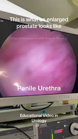 This is an educational video that shows what an enlarged prostate looks like on endoscopy #urology360 #varelaurology #manilakidneyandprostatecareclinic #fyp #fyphealth #docjongvarela #prostatecancerresearch 