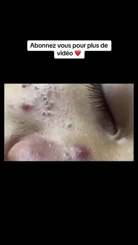 #blackhead #pimple366 #satisfying #pimplestreatment #pimple 