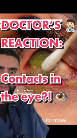 REMOVE YOUR CONTACTS! 😡#contacts #eye #doctor #tiktokdoctor #doctorsreaction #doctorreacts #ophthalmology #physician #medicine #greenscreenvideo 