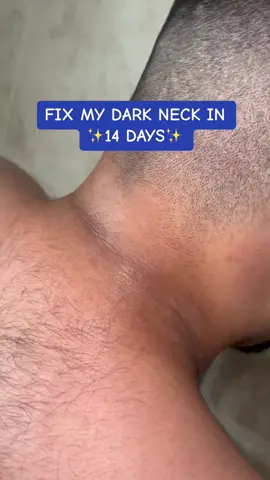 Fix my dark neck with me using 100% natural turmeric soap & oil✨ #foryoupage #foryou #trending #acne #acneskin #skin #skincare #clearskin #hyperpigmentationtreatment #desi 