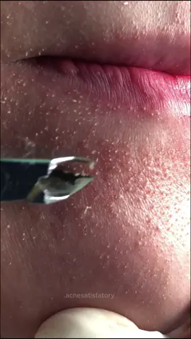 #capcut #acne #cravos #cravosgigantes #tirarcravos #asmr